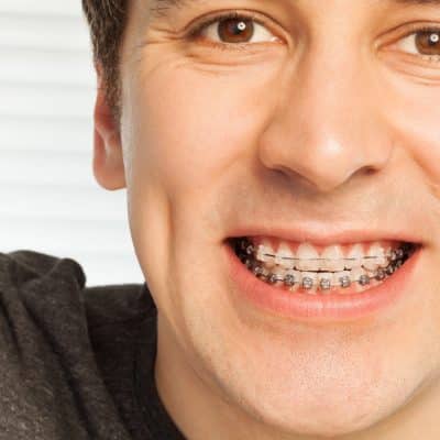 The Science Behind Straightening Teeth: How Orthodontics Works