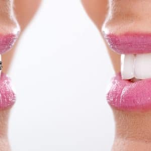 smile with braces and after treatment