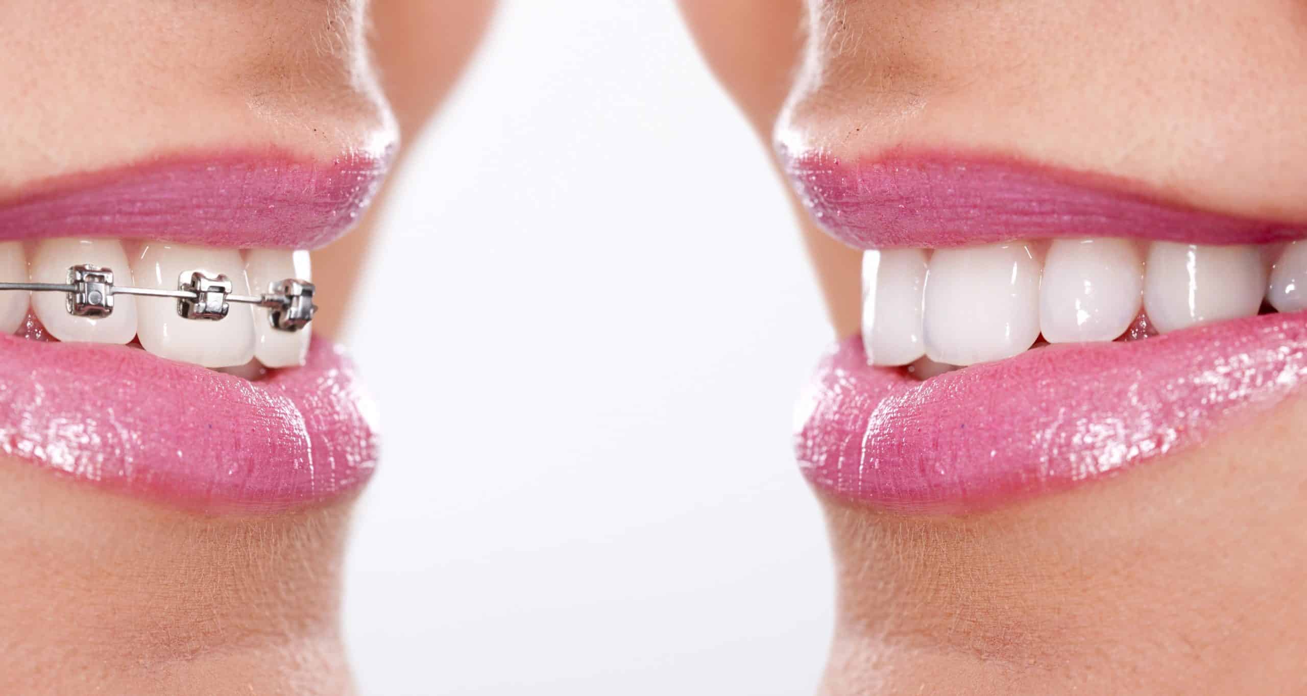 How to Keep Your Teeth Straight After Braces Without Spending a Fortune