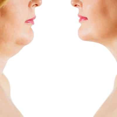 Is Double Chin Removal in Singapore Actually Worth It? Honest Results Revealed