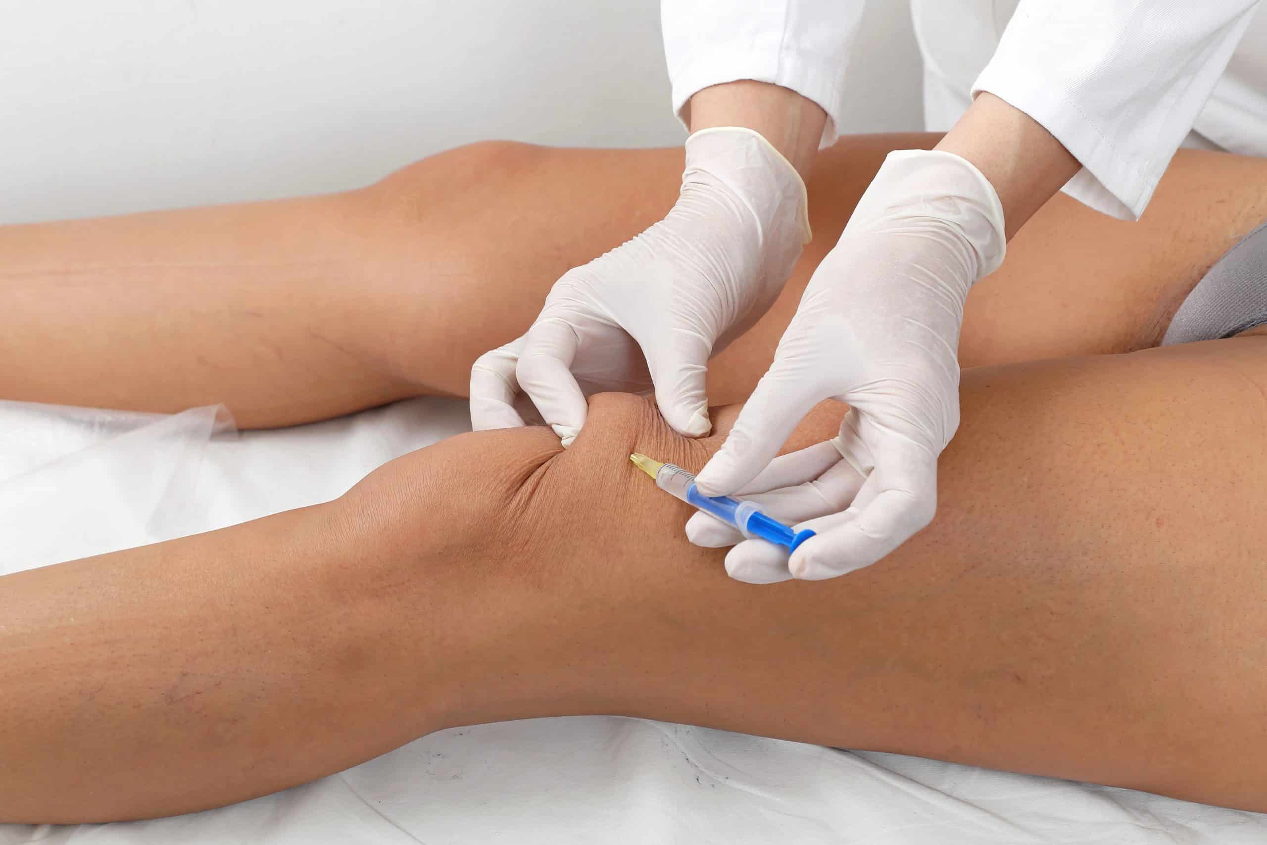 Restoring Joint Mobility: How Purified Sodium Hyaluronate Injections Support Active Lifestyles
